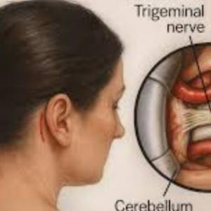 Trigeminal Neuralgia Treatment in India: Expert Advice and Care