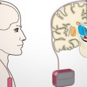 Unlocking Hope: DBS for Advanced Parkinson’s Disease in Kolkata