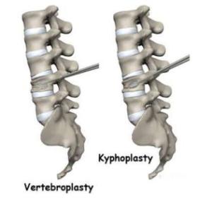 Vertebroplasty and Kyphoplasty Recovery Time in the Elderly: Consult a Top Spine Surgeon in India
