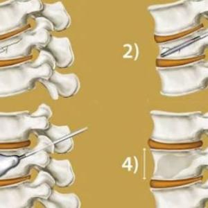 Vertebroplasty and Kyphoplasty Recovery Time in the Elderly: What to Expect