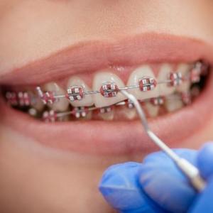 Achieve Straighter Teeth and a Confident Smile with Braces Treatment