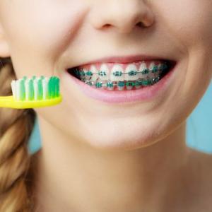 How to Maintain Oral Hygiene with Braces