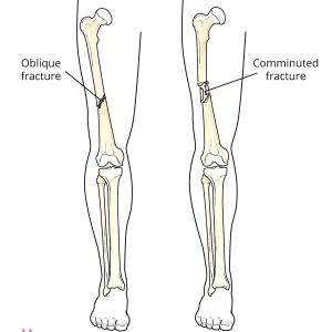 An Educational Guide to Femoral Shaft Fractures