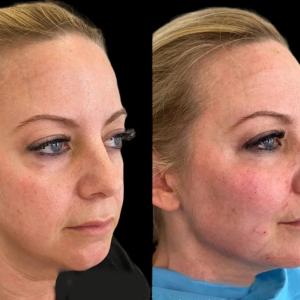Cheek Fillers Treatment in Dubai: A Step-By-Step Guide to the Procedure