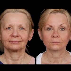 Under Eye Fillers Treatment in Dubai: Is It a Long-Term Solution?