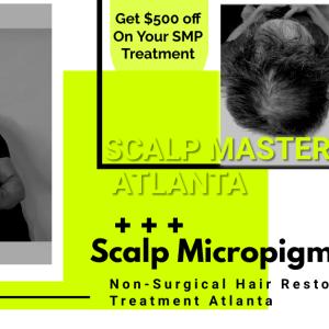 The Benefits of Scalp Micropigmentation