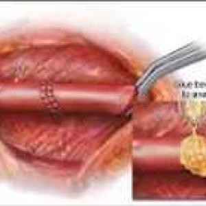 Global Tissue Sealants and Tissue Adhesive Market, Research Report