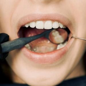 Young Smiles at Risk: Stopping Early Tooth Loss in Your 20s and 30s