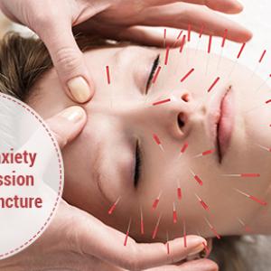 Acupuncture for Anxiety and Depression