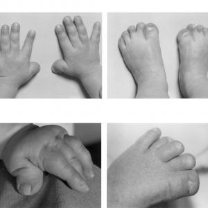 Achondroplasia Therapeutics Market