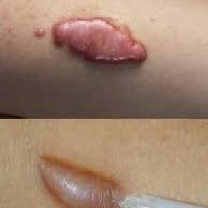 Hypertrophic And Keloid Scar Treatment Market