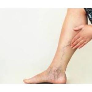 Varicose Veins Treatment Market