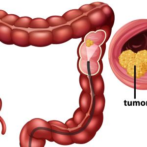 Colorectal Cancer Screening Market size, Trends and Forecast (2023-2033)
