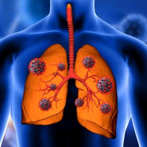 Extensive Stage Small Cell Lung Cancer Market Report - Focuses on Epidemiology, Product, and Region