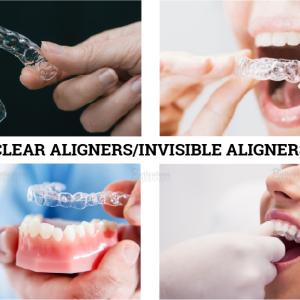 Clear Aligners Market