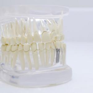 What to expect during dental implant treatment?