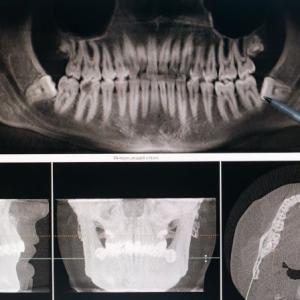 Signs of Infection After Wisdom Teeth Removal and When to See a Doctor
